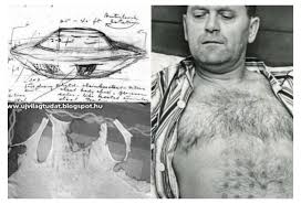 Stefan Michalak showing grid-pattern burn marks on his chest following the 1967 Falcon Lake UFO encounter